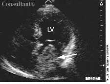 Atrial Myxoma That Mimics Mitral Stenosis