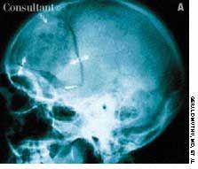 Migrated Intracranial Aneurysm Clip