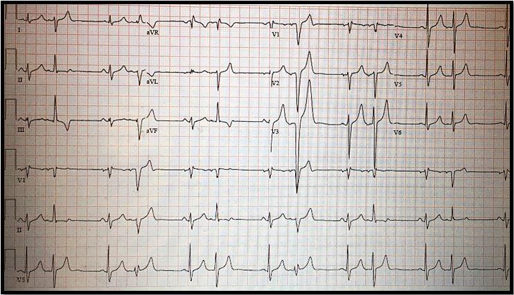 Premature atrial contractions, bigeminy 