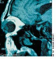 Malignant Lymphoma of the Orbit