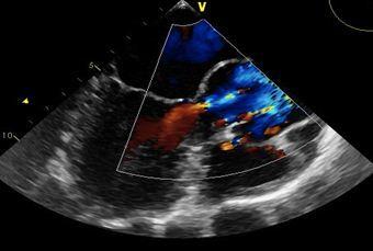 Patent Foramen Ovale and Paradoxical Stroke in a Young Cyclist