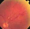 Branch Retinal Vein Occlusion