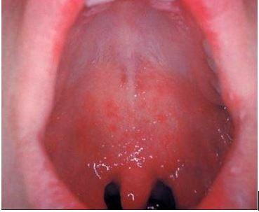 Koplik spots on the palate 
(Courtesy of CDC) 