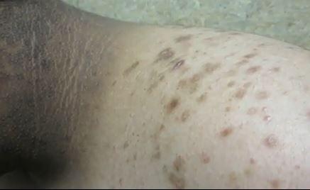 13-year-old With Hyperpigmented Rash