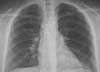 Spontaneous Pneumothorax