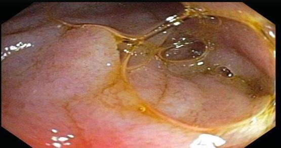 Superior Mesenteric Artery Syndrome in a Young Woman 