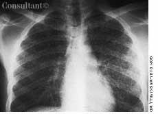 Miliary Tuberculosis