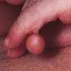 Polydactyly